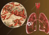 Pasien TBC Harus Lebih Mewaspadai Virus Corona