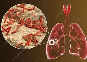 Ilsutrasi tuberkulosis pulmonari. Foto: sciencephoto
