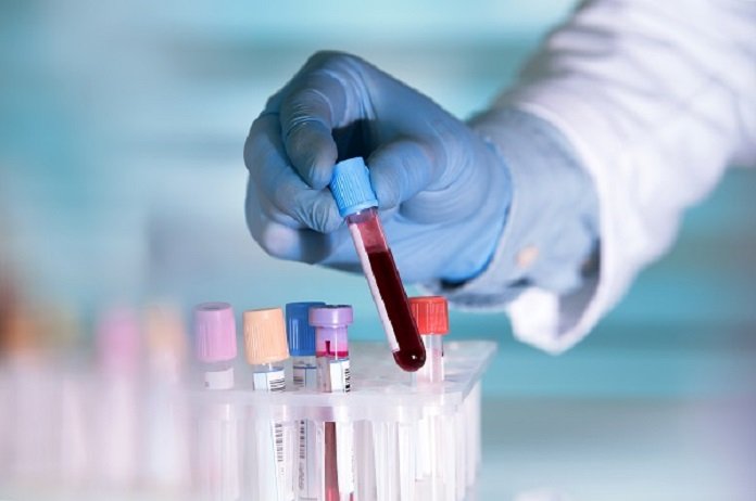 Kini, Tingkat Keparahan Covid-19 dapat Diprediksi dari Protein Dalam Darah Pasien