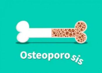 Wanita Memiliki Risiko Lebih Tinggi Terkena Osteoporosis